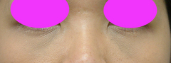 WPRPF lowerlid 30y after-thumb-500x187-1337.jpgのサムネール画像